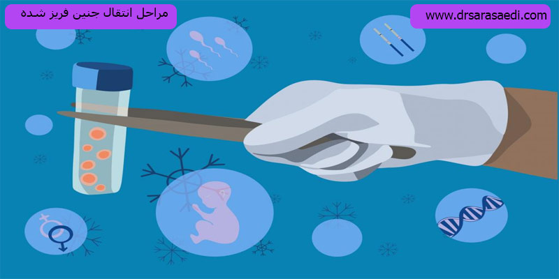 مراحل-انتقال-جنین-فریز