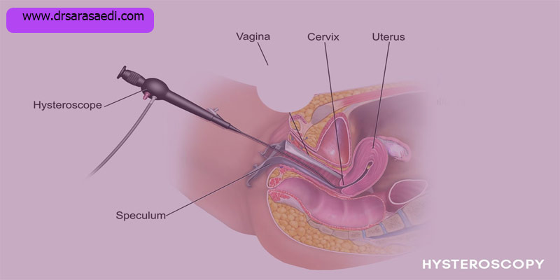 هیستروسکوپی-و-مزایا