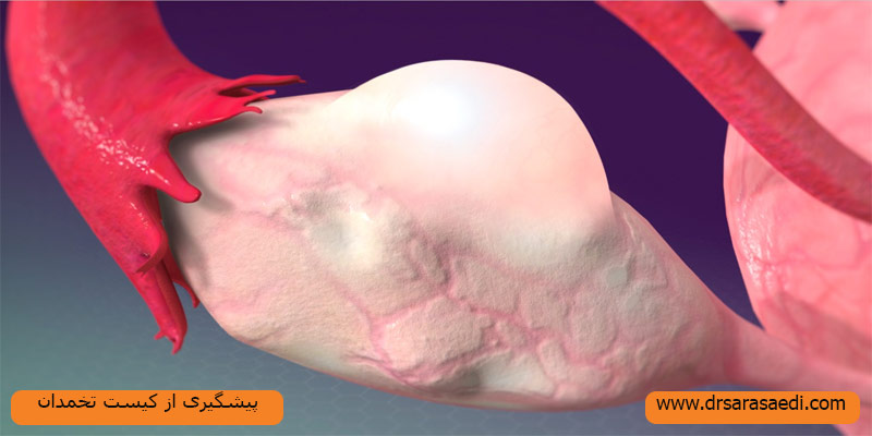 پیشگیری-از-کیست-تخمدان