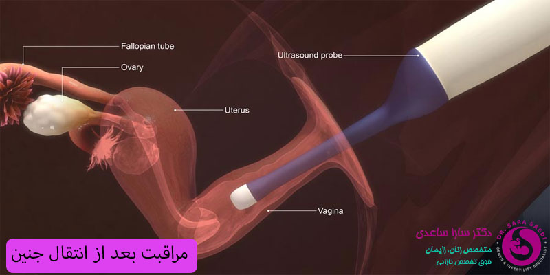 مراقبت-بعد-از-انتقال-جنین