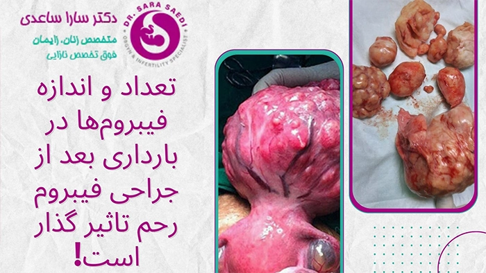 تعداد و اندازه فیبروم