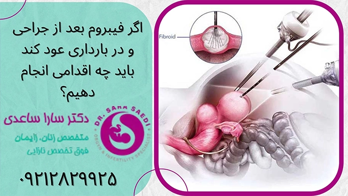 عود فیبروم در بارداری