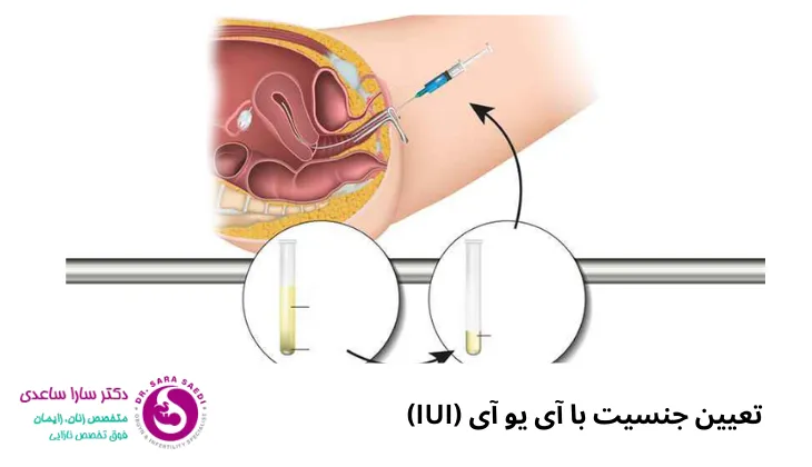 تعیین جنسیت با آی یو آی (IUI)