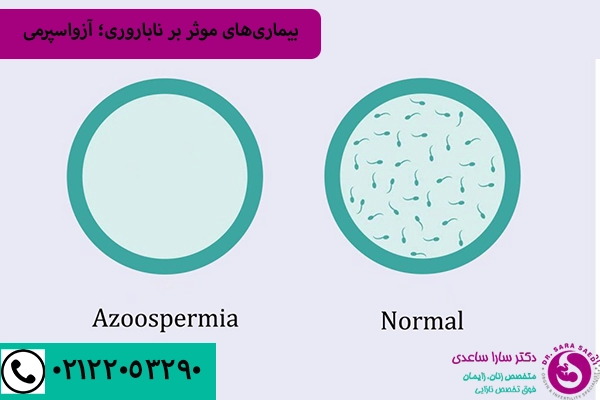 آزواسپرمی و ناباروری