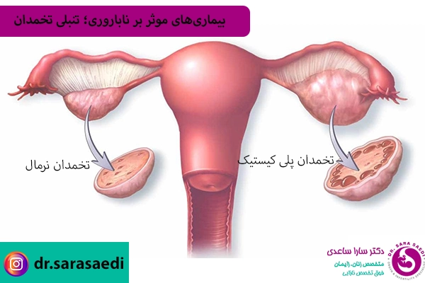 تنبلی تخمدان و ناباروری