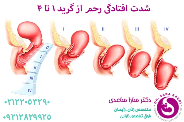 افتادگی رحم