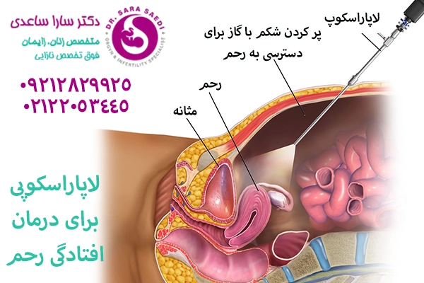 لاپاراسکوپی برای درمان افتادگی رحم